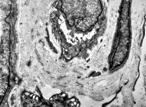 F,48y. | reduplication of endothelial basement membranes - skin - susp. lupus erythematodes